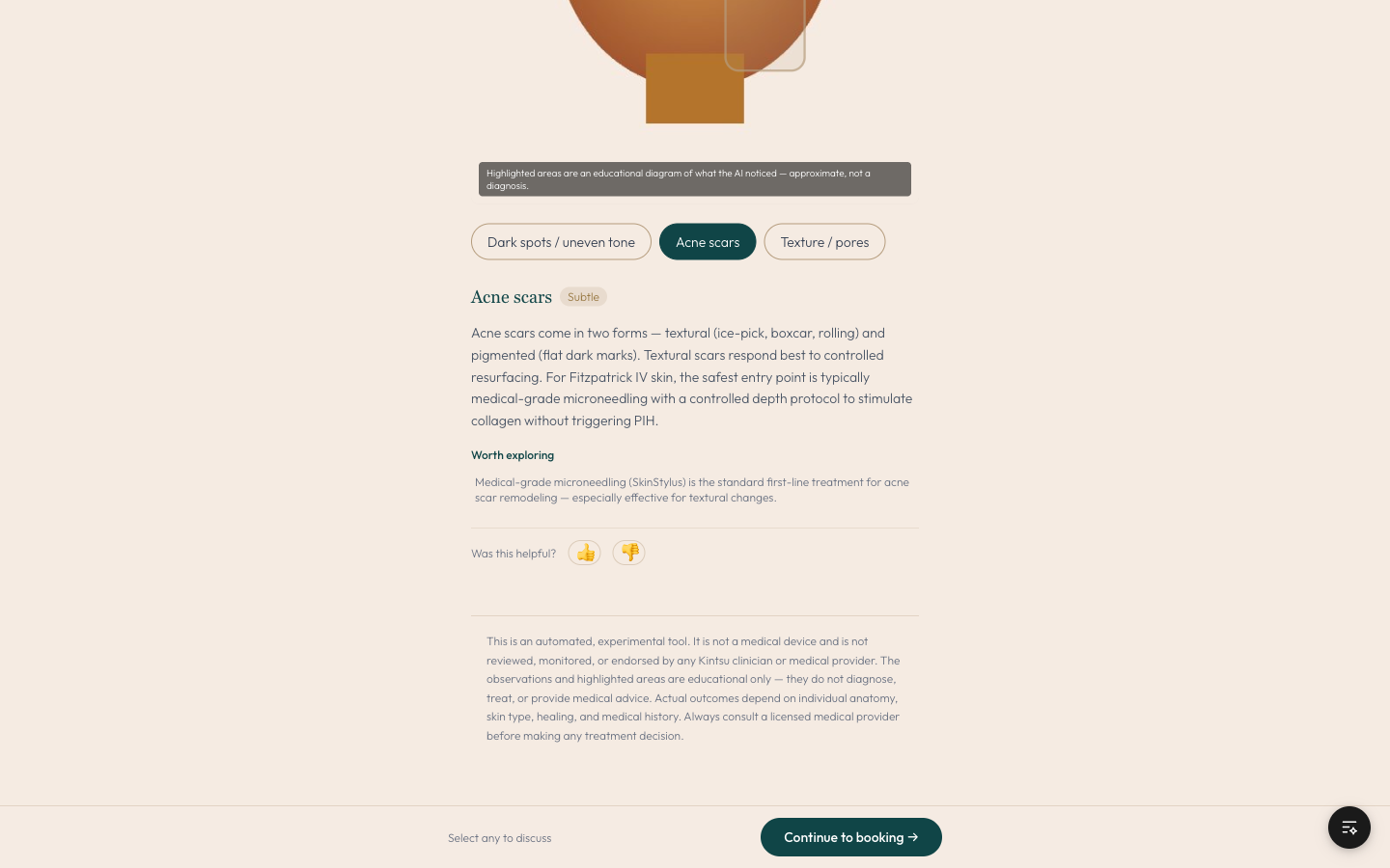 Acne scars tab showing Subtle severity badge, educational copy about PIH risk for Fitzpatrick IV skin when considering microneedling, and a Worth exploring section recommending medical-grade microneedling with physician-supervised depth protocol